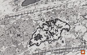 M, 7w. | mitochondrial cardiomyopathy (N - nucleus, M - megamitochondria,R - dilated endoplasmic reticulum)- autopsy sample